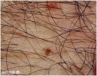 陰毛 毛囊炎